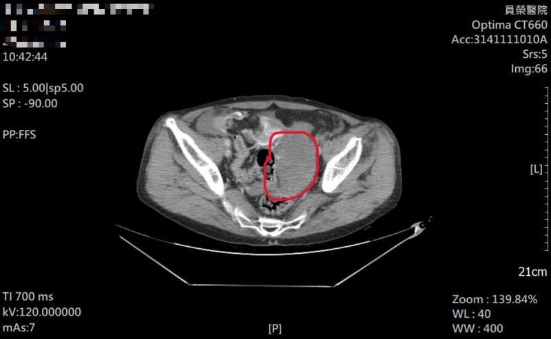躺平不痛站起劇痛？揭密「姿勢痛」警訊：6旬男腹腔大出血險奪命