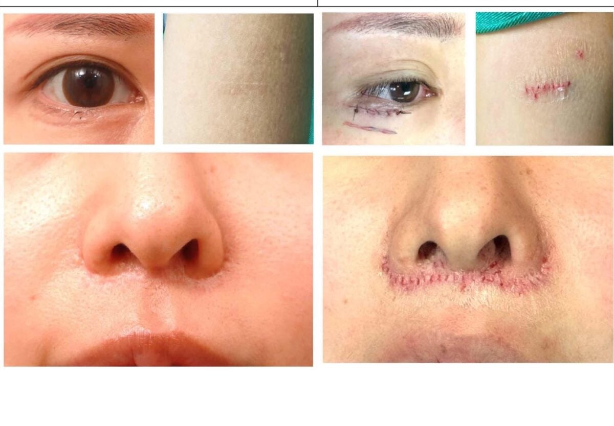 台灣白疤醫療躍國際：曹賜斌醫師助日本患者重生，數據揭示跨海信任