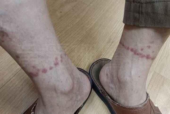 清明掃墓當心「腳踝紅圈」 皮膚科醫師揭昆蟲叮咬特徵