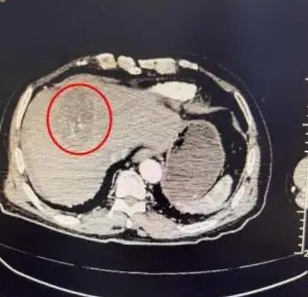 七旬婦跳廣場舞動作過猛 竟致肝腫瘤破裂險喪命