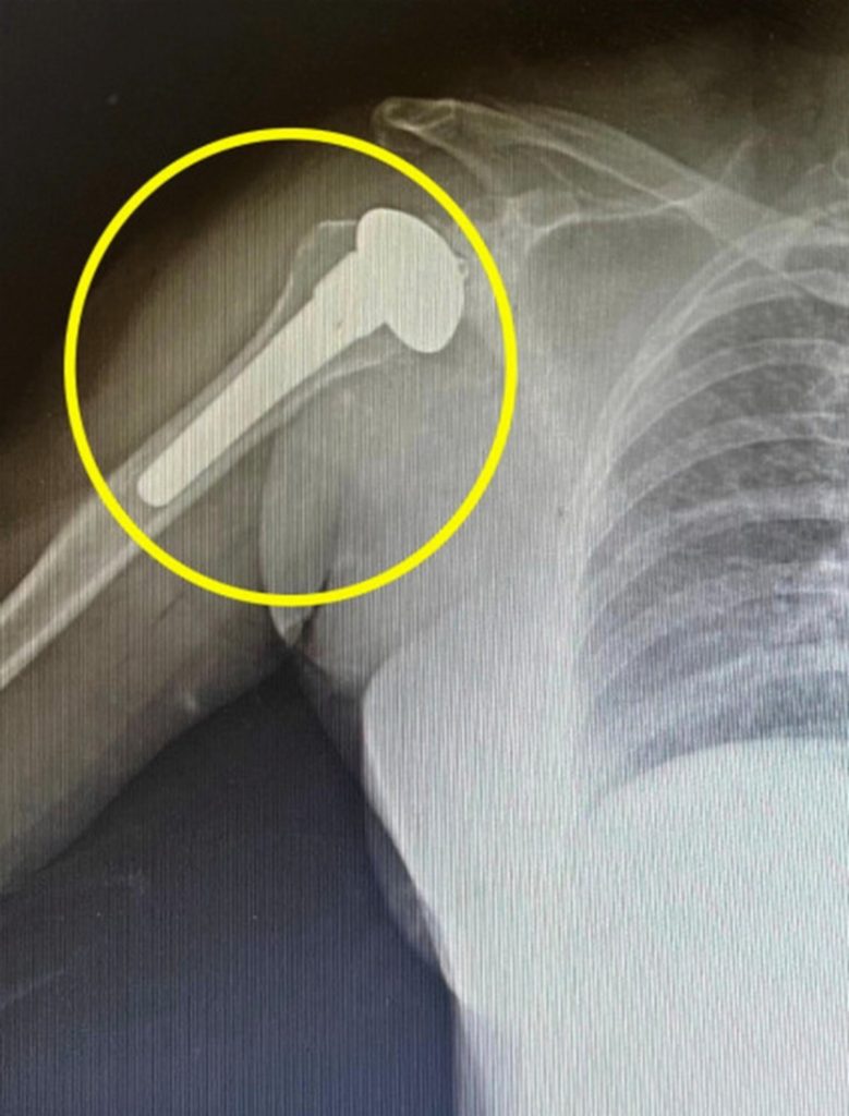 女運將肩痛誤當五十肩 人工關節置換術助重返方向盤