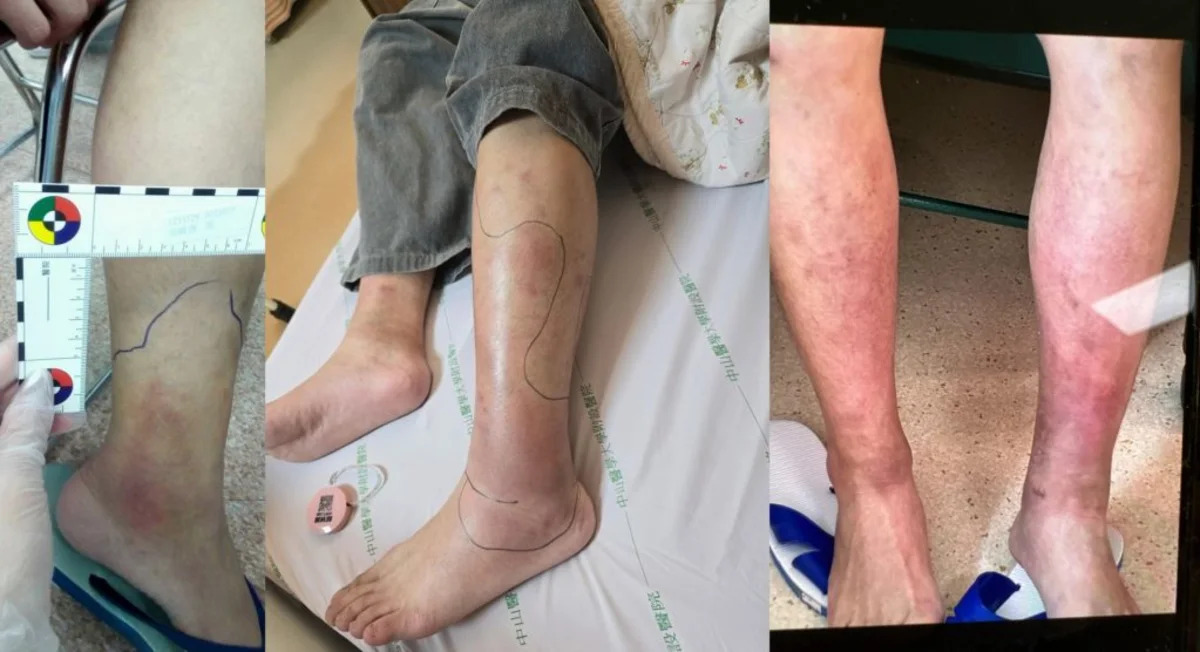 25歲象腿青年絕處逢生：姊姊一「髓」相救，罕病奇蹟如何改寫命運？